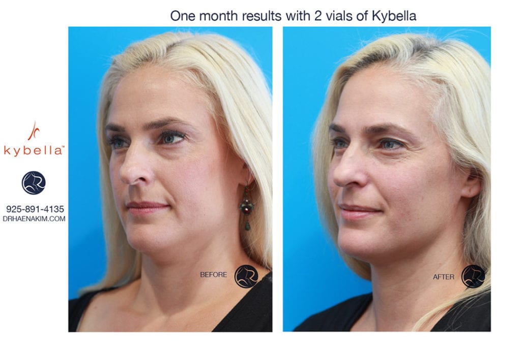 Kybella Walnut Creek, CA Dr Haena Kim